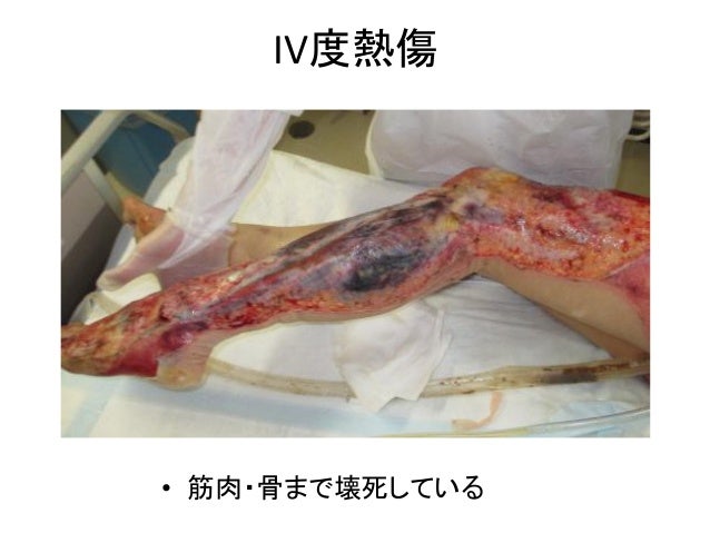 20. IV度